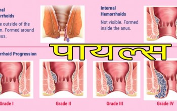 के हो पाइल्स ? कसरी बच्ने ?